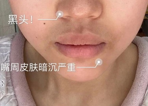 沈阳化妆学校唇周暗沉的真正原因是什么